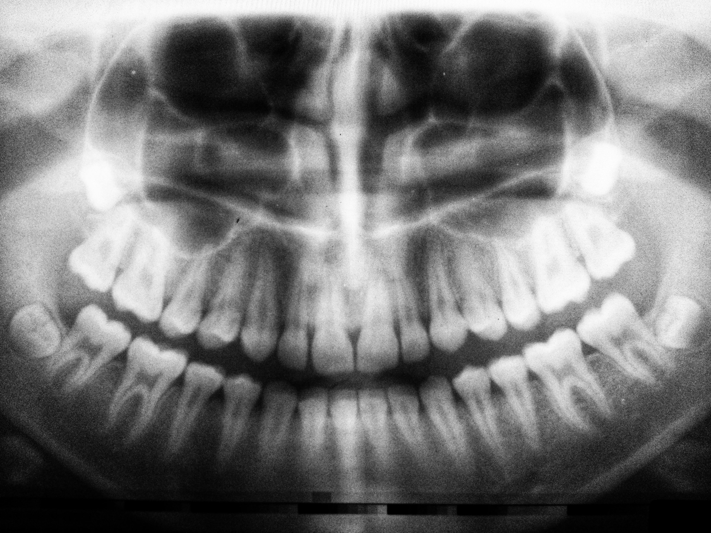 panoramaroentgen-kiefer-cmd-funktionsdiagnostik Panoramaröntgen des Kiefers zur zahnärztlichen Diagnostik bei CMD und Kiefergelenkschmerzen
