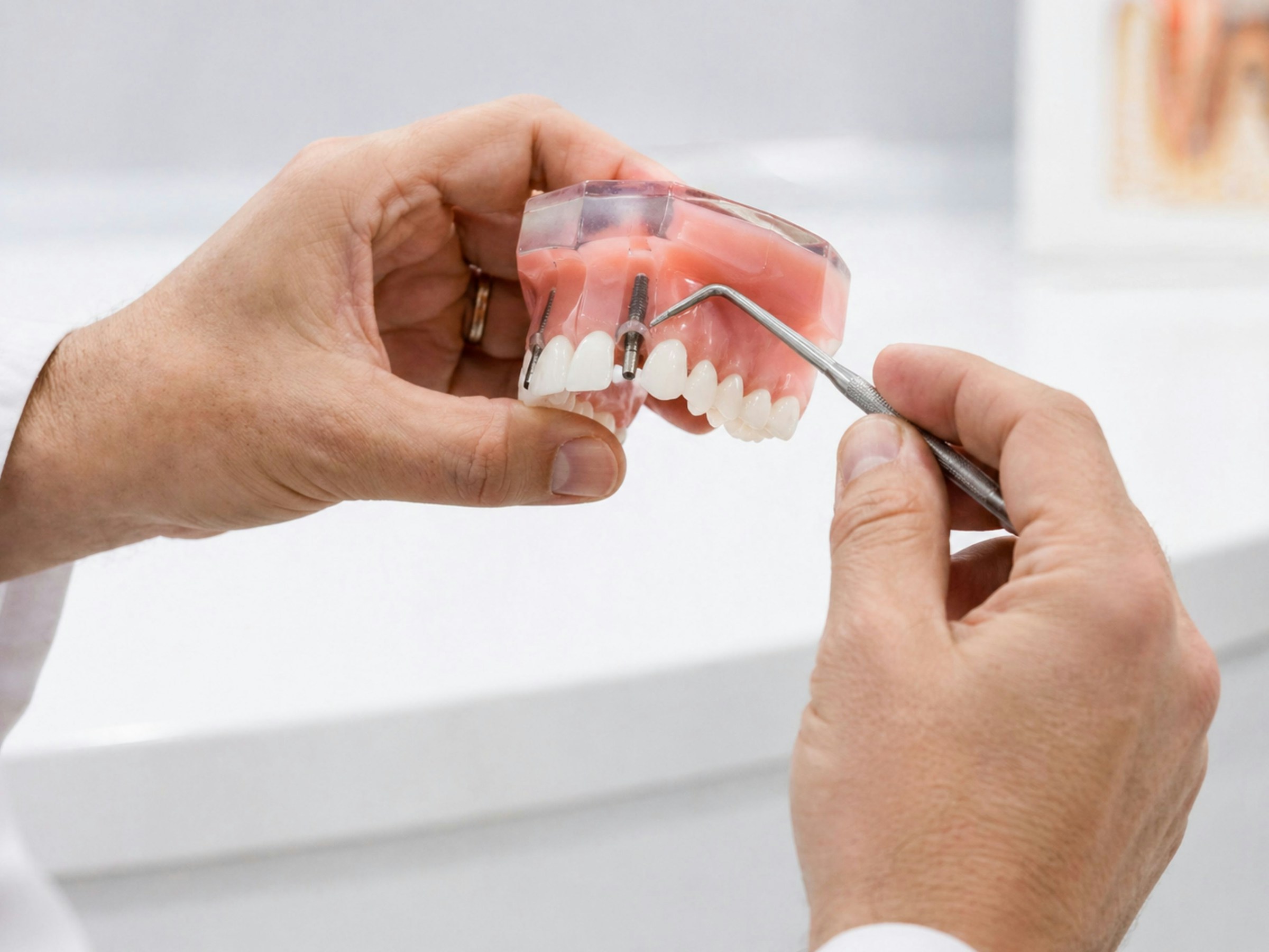 Zahnimplantat in Berne: Kosten, Ablauf, Haltbarkeit & Festzuschuss 3 Zahnarzt erklärt Zahnimplantate am Kiefermodell – Ablauf der Implantatbehandlung in Berne